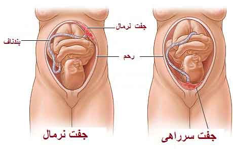 جفت سرراهی چیست؟ 