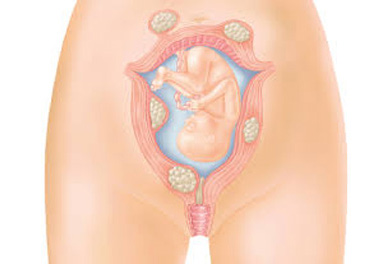 فیبروم رحم در بارداری