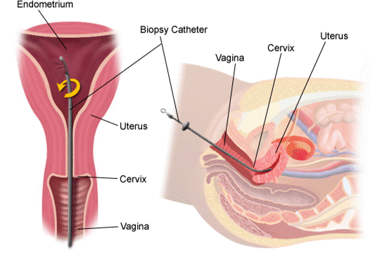 بیوپسی آندومتر 