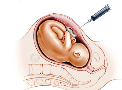 همه چیز درباره ی آمنیوسنتز