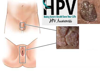 زگیل تناسلی (HPV)