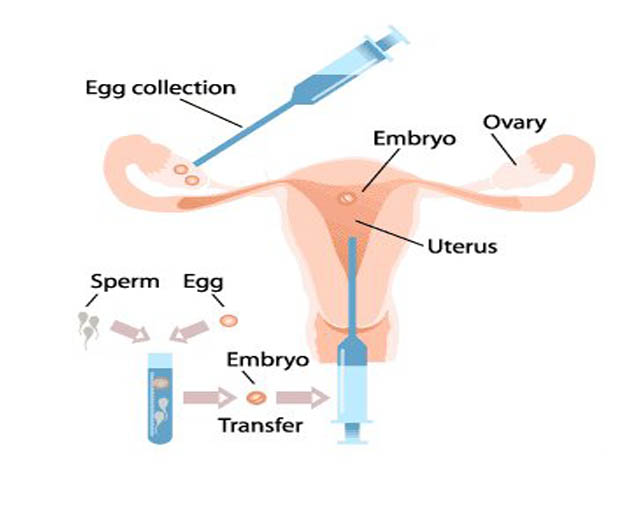 مقایسه روش های IUI و IVF