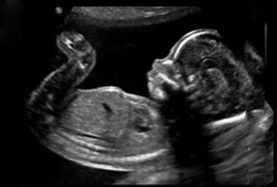 عکس جنین پسر در سونوگرافی