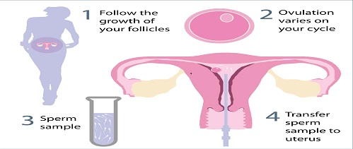  آیا IUI ( لقاح مصنوعی) برای شما مناسب است؟