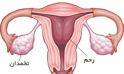 علایم عفونت رحم پس از زایمان طبیعی و سزارین