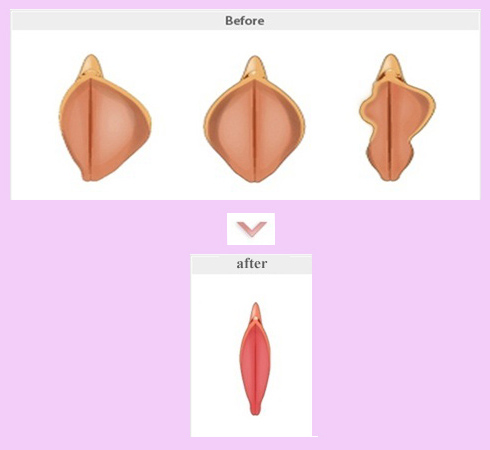 عمل جراحی زیبایی واژن (لابیاپلاستی) 