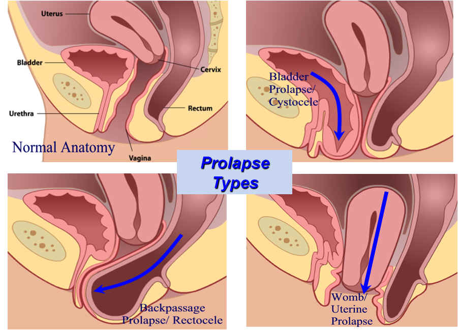 انواع پرولاپس (افتادگی - فتق) واژن و تعریف آن 
