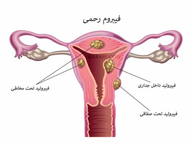 فیبروم رحم در بارداری
