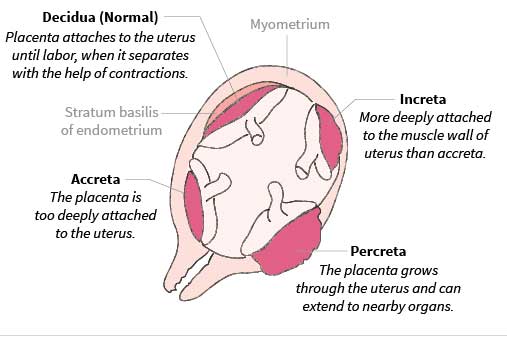Placental accreta, increta and percreta