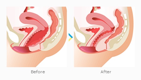 عمل تنگ کردن واژن یا پرینورافی