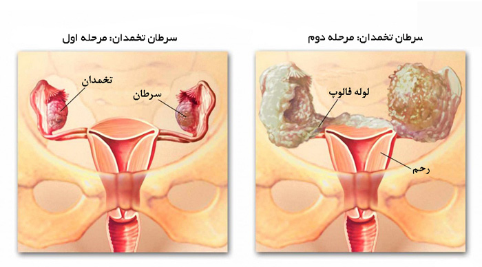 علائم اولیه سرطان تخمدان