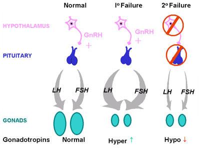 هیپوگنادیسم در خانمها Hypogonadism in females  