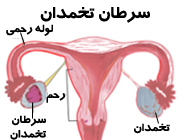 چه عواملی باعث سرطان تخمدان می شوند؟