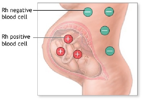 ناسازگاری RH خون مادر و جنین