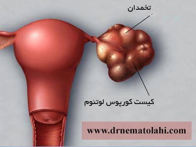 کیست کورپوس لوتئوم یا کیست جسم زرد در بارداری