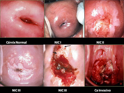 مراحل سرطان دهانه رحم - سرویکس