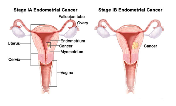 در مورد سرطان آندومتر جه می دانید