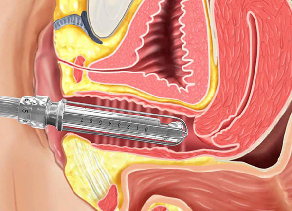 تنگ کردن واژن با لیزر 