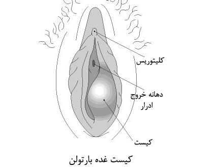 روش های درمانی کیست بارتولن