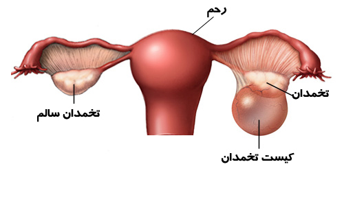 کیست تخمدان