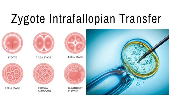 درمان ناباروری با روش ZIFT