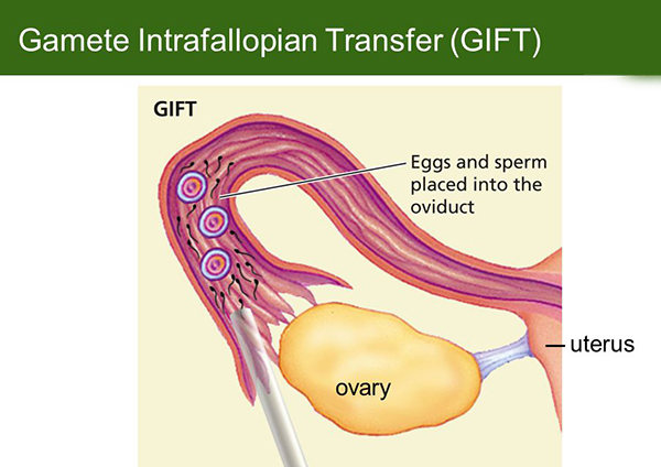 درمان ناباروری با روش GIFT