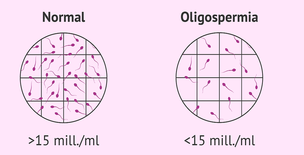 الیگواسپرمی یا کمی اسپرم، علت و درمان آن