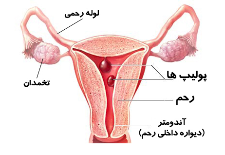 روش های درمانی پولیپ رحم و دهانه رحم