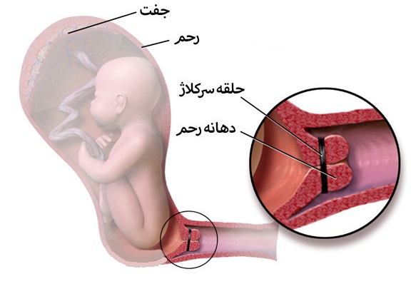 علل و درمان ضعف یا نارسایی دهانه رحم 