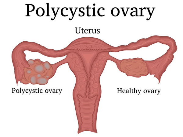 تنبلی تخمدان یا تخمدان پلی کیستیک؟!