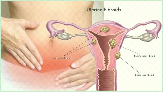 آیا فیبروم رحم با نازایی و سرطان رحم رابطه ای دارد؟