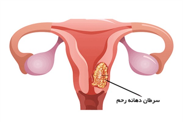 تشخیص زودرس سرطان دهانه‌ی رحم