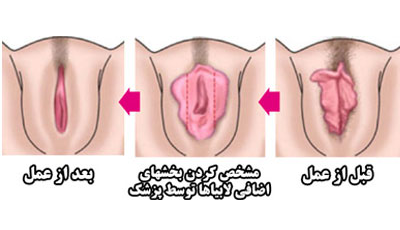 به چه دلیل بانوان نیازمند جراحی لابیاپلاستی هستند؟