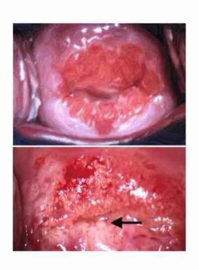 التهاب دهانه رحم، علل، تشخیص و پیشگیری از آن 