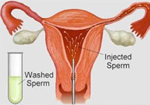 درمان ناباروری با IUI