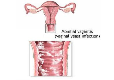 درمان خارش و سوزش شدید به علت عفونت قارچی واژن