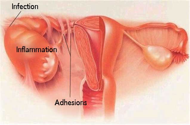 التهاب لگن در زنان