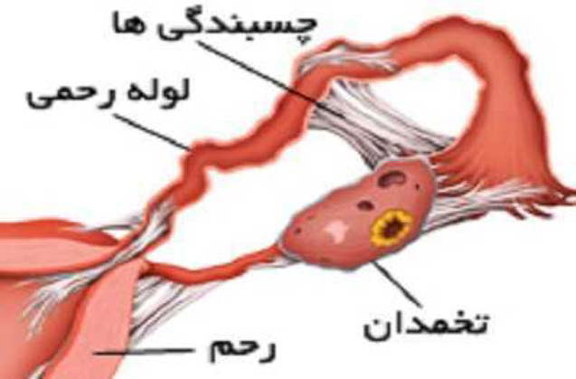 چسبندگی لوله ها ی رحمی