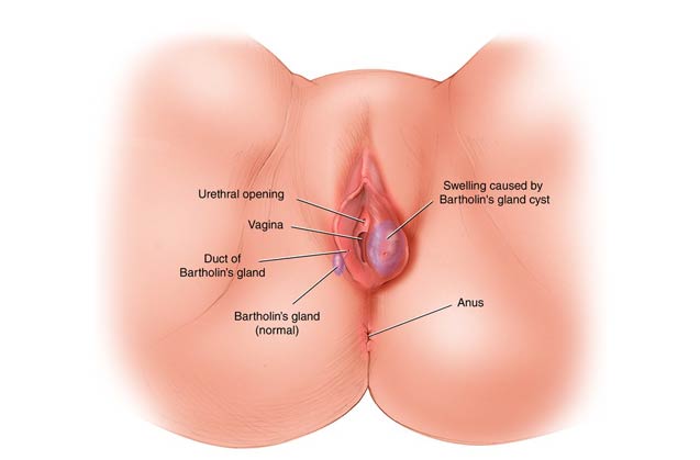 کیست بارتولن( Bartholin