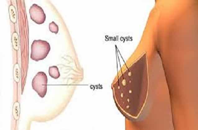 کیست های سینه	