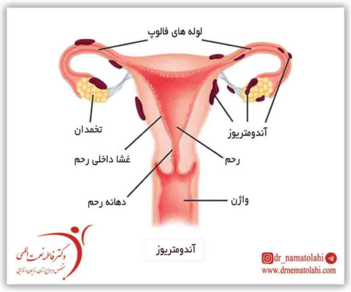 آندومتریوز