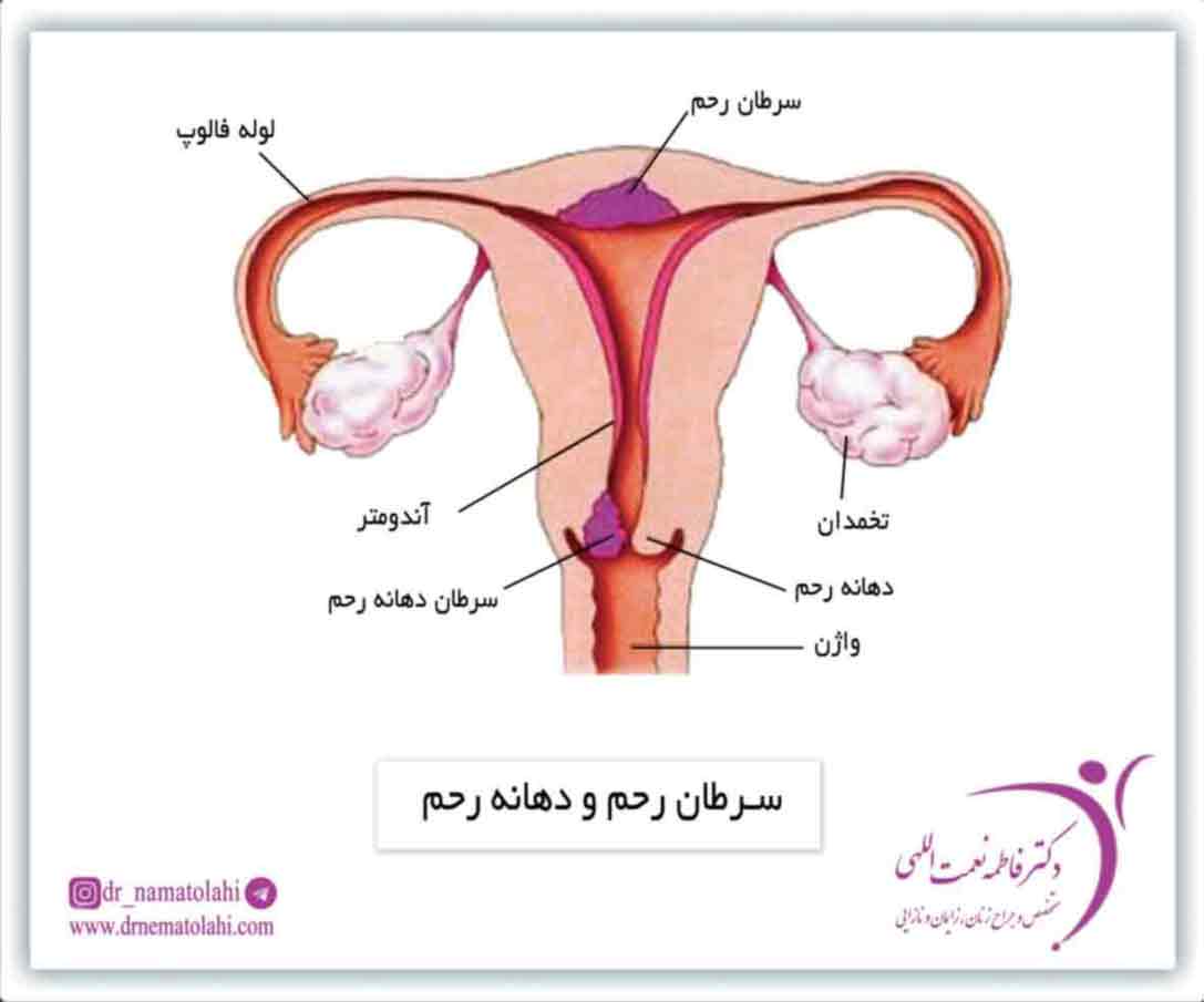 سرطان رحم و دهانه رحم