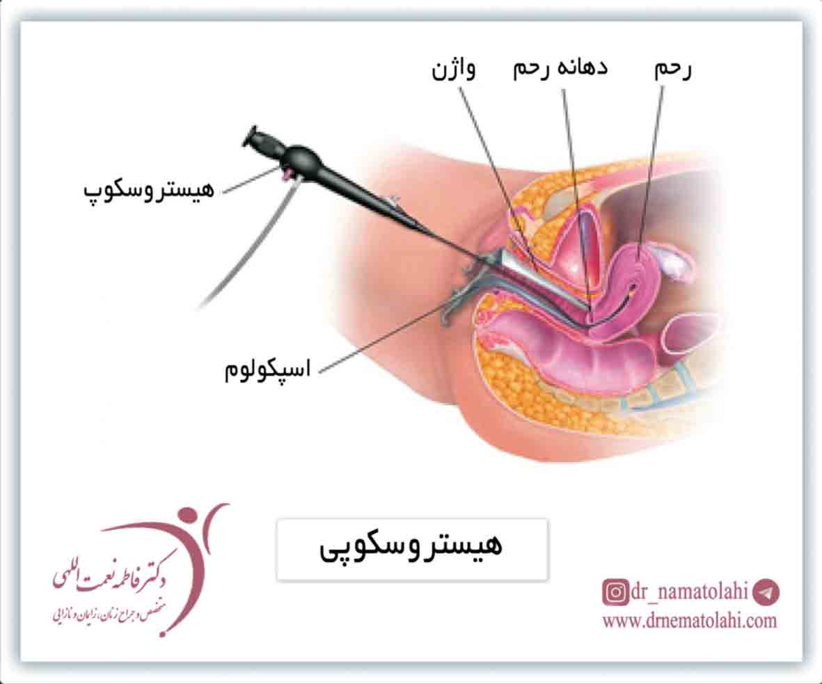 هیستروسکوپی