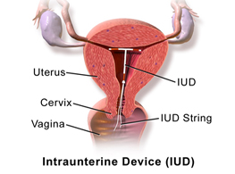 روش جلوگیری از بارداری:IUD